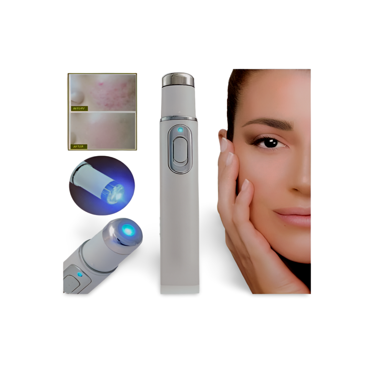 Acne Laser Pen